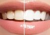 Some Tips to Keep Your Teeth White and Naturally