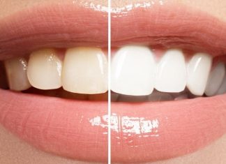 Some Tips to Keep Your Teeth White and Naturally